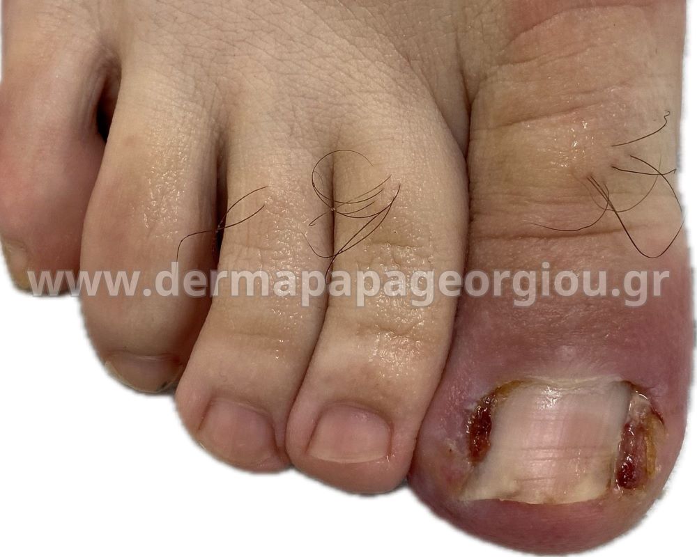 eisfrysi-onychos-aitia-sybtomata-therapeia.jpg