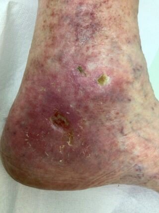 Πολλαπλές ξηροδερμικές ελκώσεις στο πόδι ασθενούς με χρόνια φλεβική ανεπάρκεια και σακχαρώδη διαβήτη τύπου 2, με σημάδια μικροαγγειακής και περιφερικής αρτηριακής νόσου.