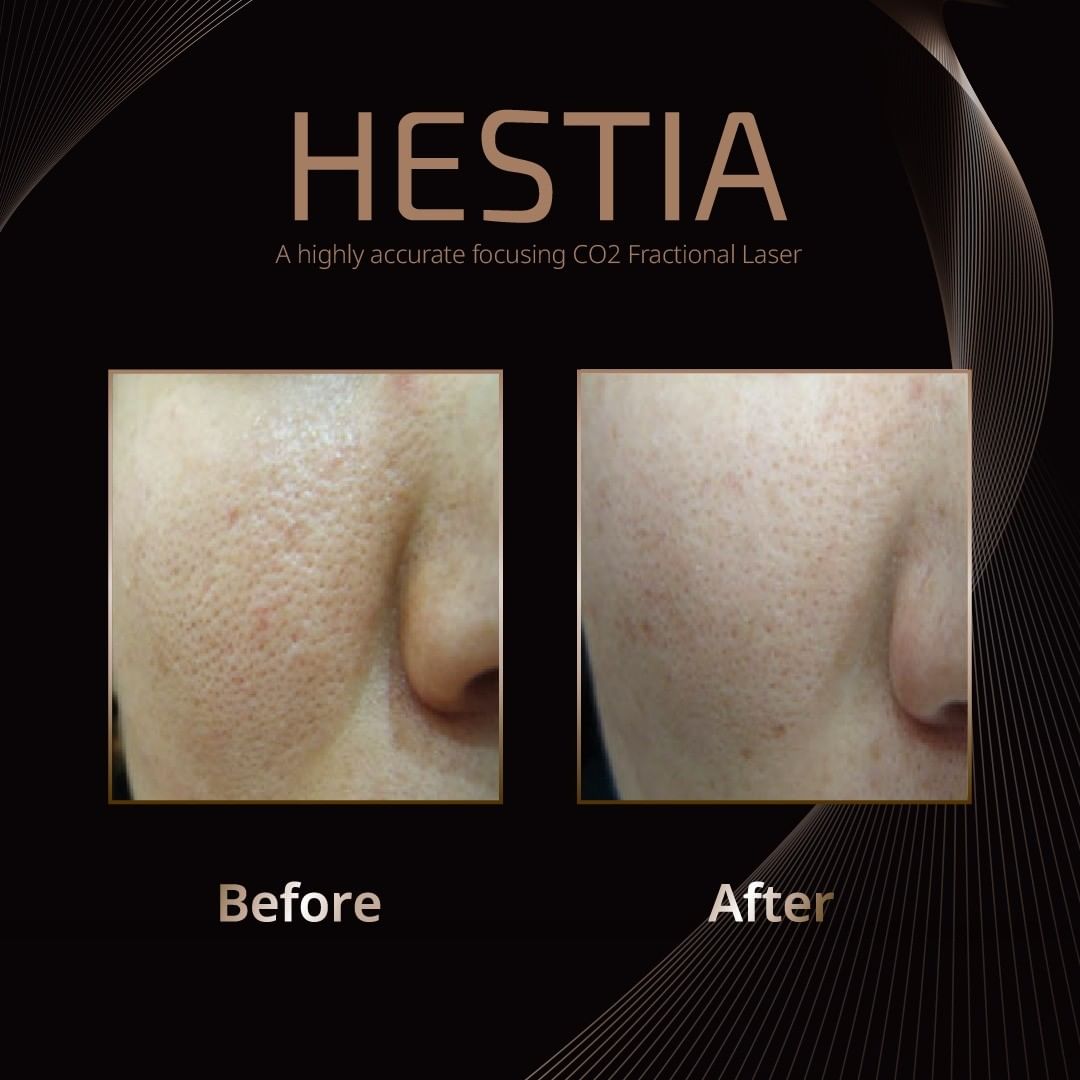 HESTIA POST 5B HESTIA POST 5B