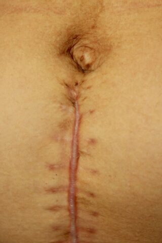 oules dermatos aitia kai sygchrones methodoi antimetopisis ypertrofiki ouli Υπερτροφική μετεγχειρητική ουλή στην κοιλιακή χώρα, με γραμμική υπερύψωση και ερυθρότητα κατά μήκος της τομής.